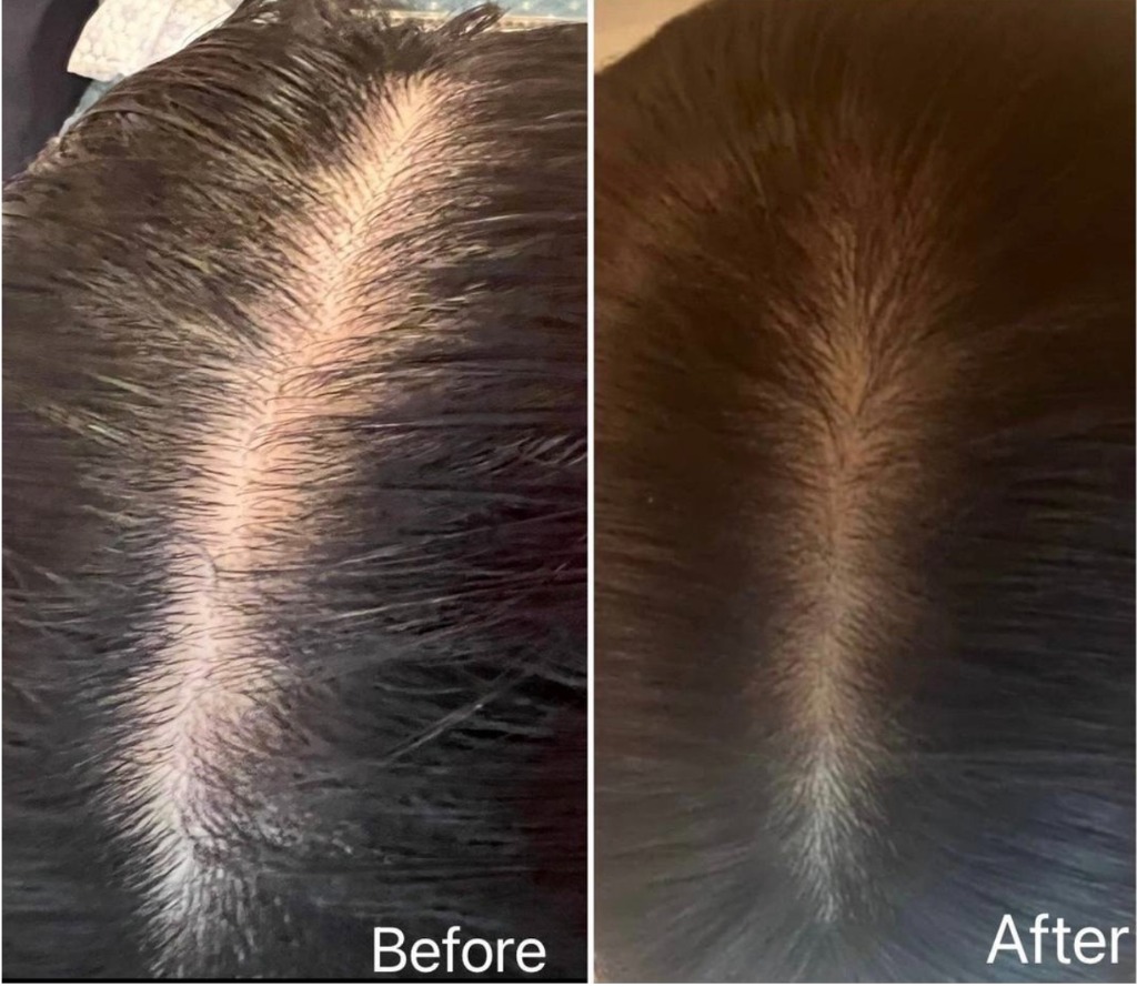 頭皮の育毛ケアも始めました～